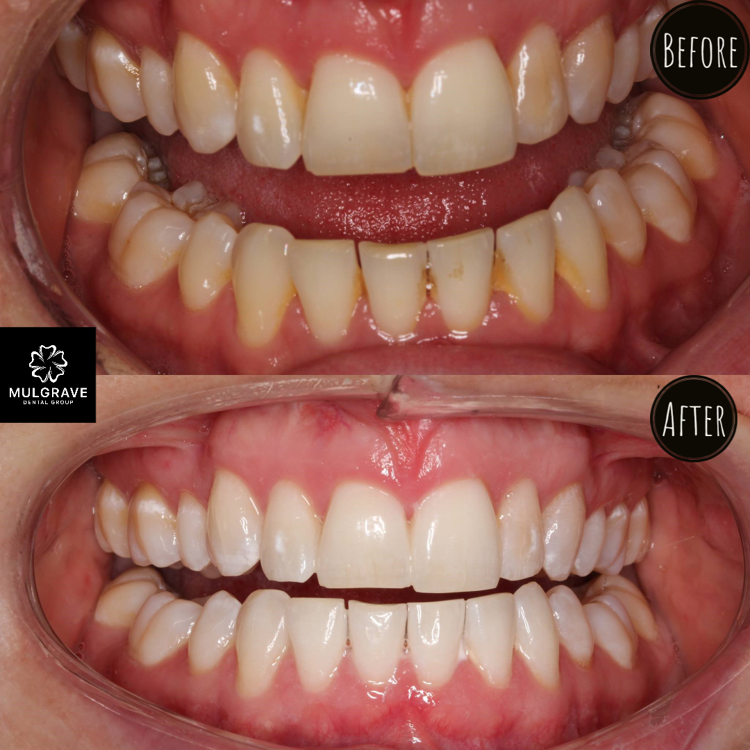 Zoom Teeth Whitening Melbourne Mulgrave Dental